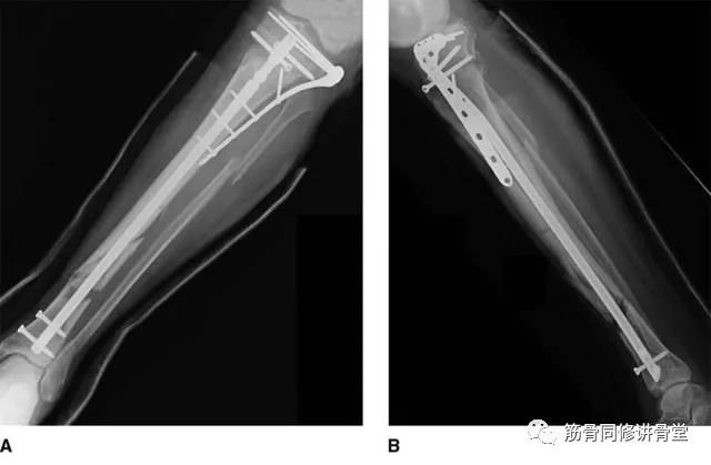 髓内钉治疗胫骨近端及远端骨折争议 好医术早读文章 好医术 赋能医生守护生命