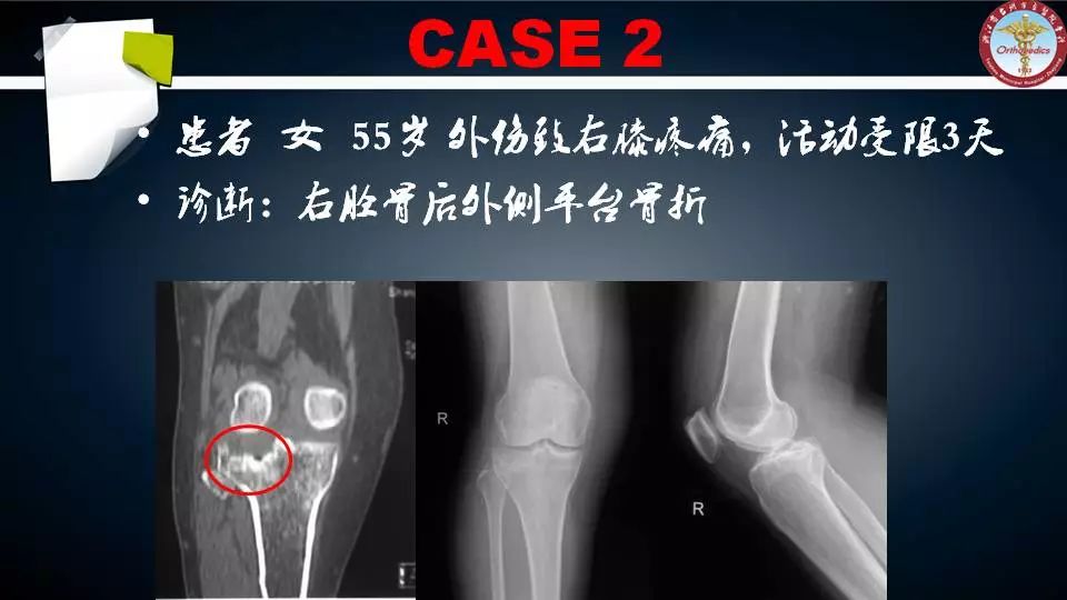 腓骨头截骨入路治疗胫骨后外侧平台骨折 好医术早读文章 好医术 赋能医生守护生命