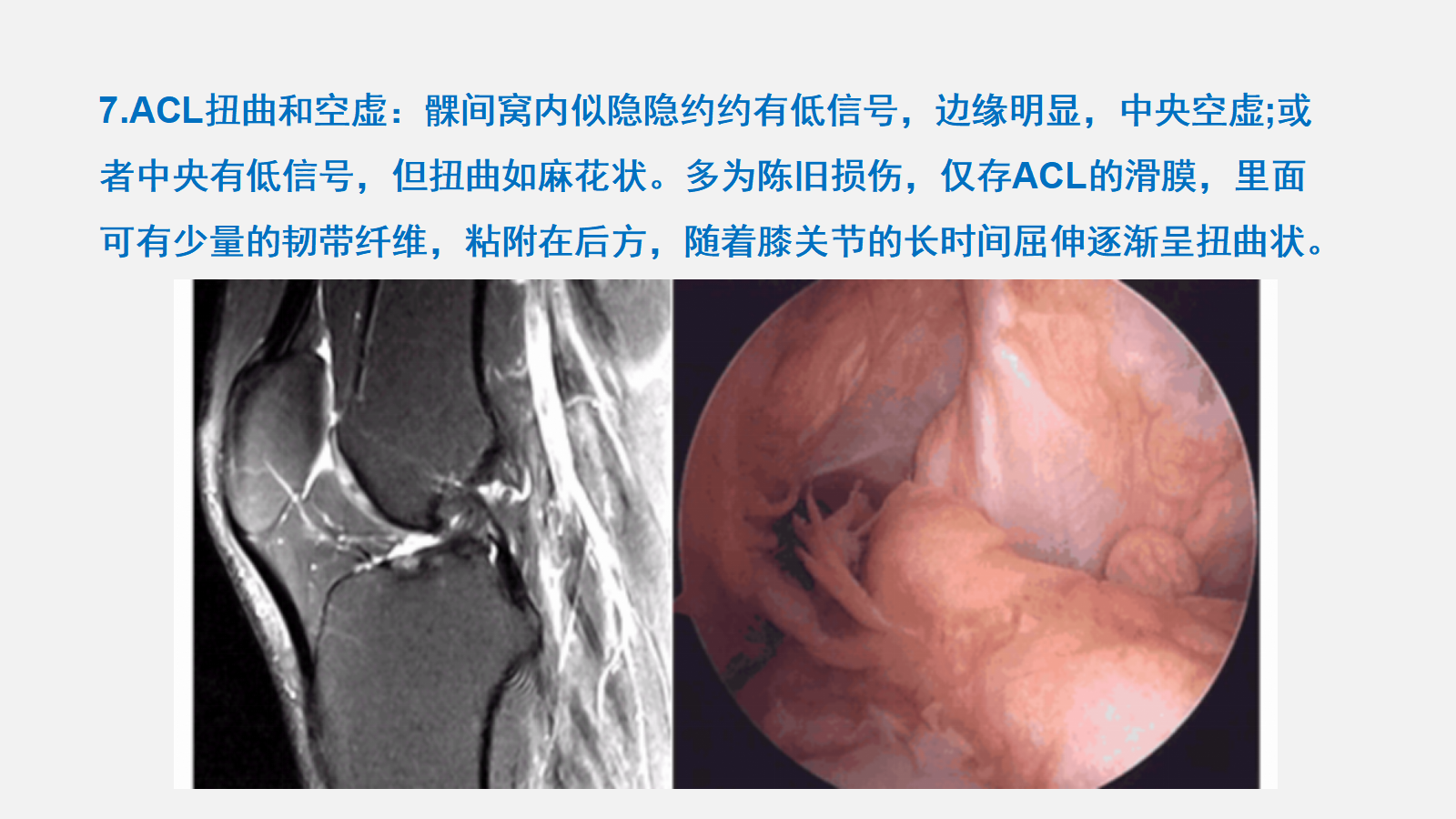 踝关节外侧韧带急性损伤的MRI表现_诊断