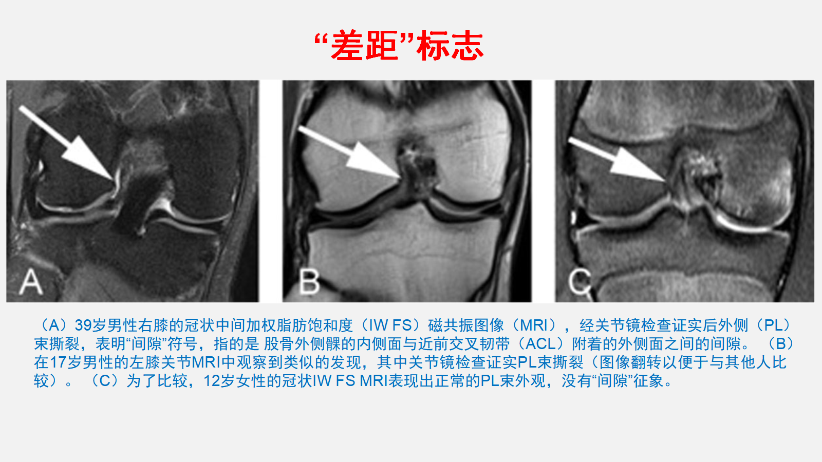 二、膝关节镜下前交叉韧带止点重建术-外科学-医学