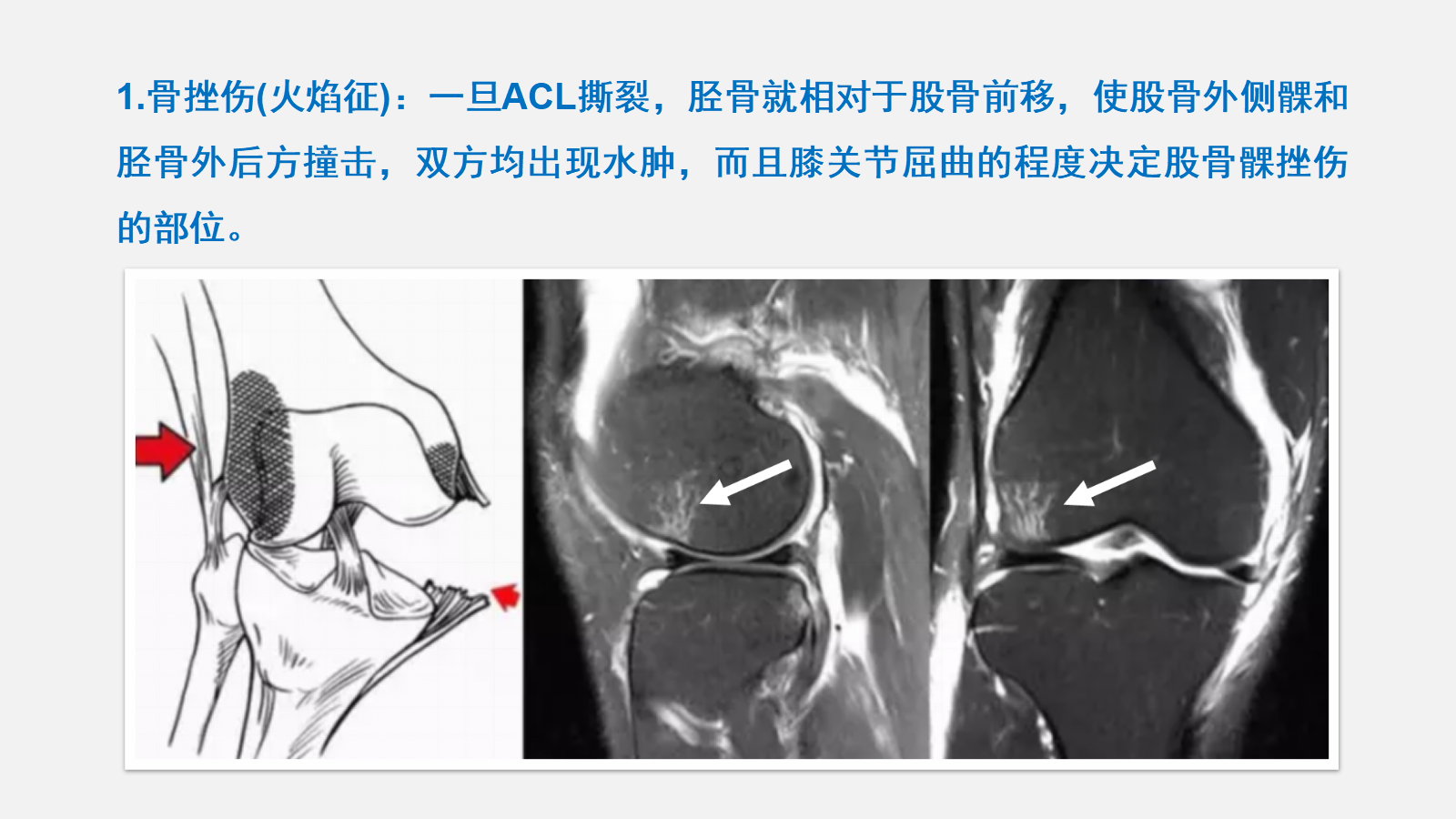 广州市民肘部扭挫伤治疗和肘部扭挫伤预防 - 知乎