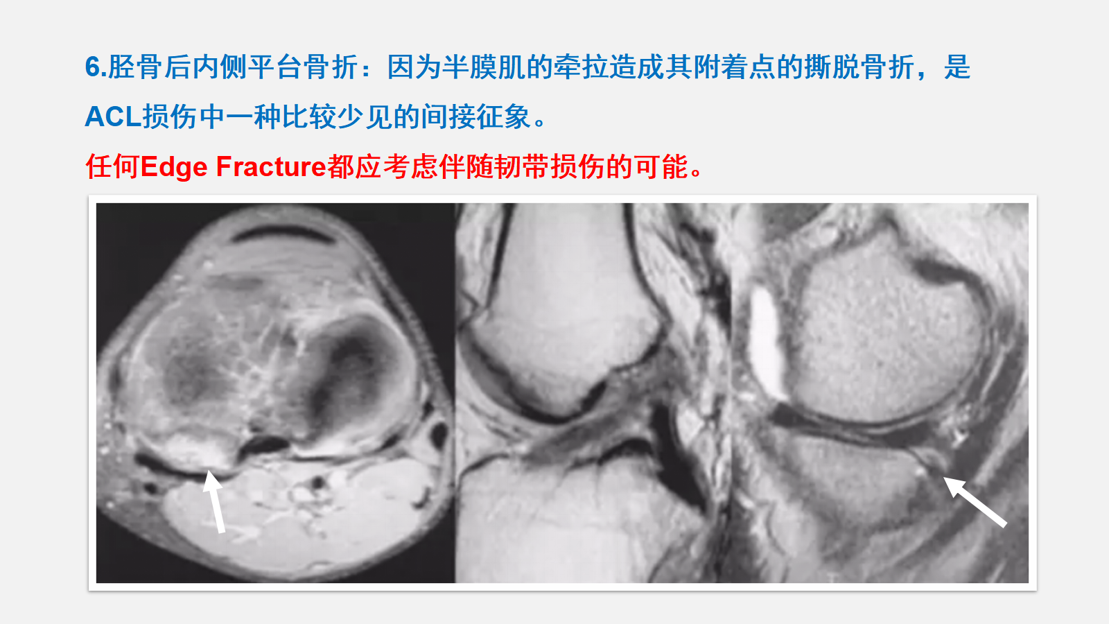踝关节外侧韧带急性损伤的MRI表现 - 知乎