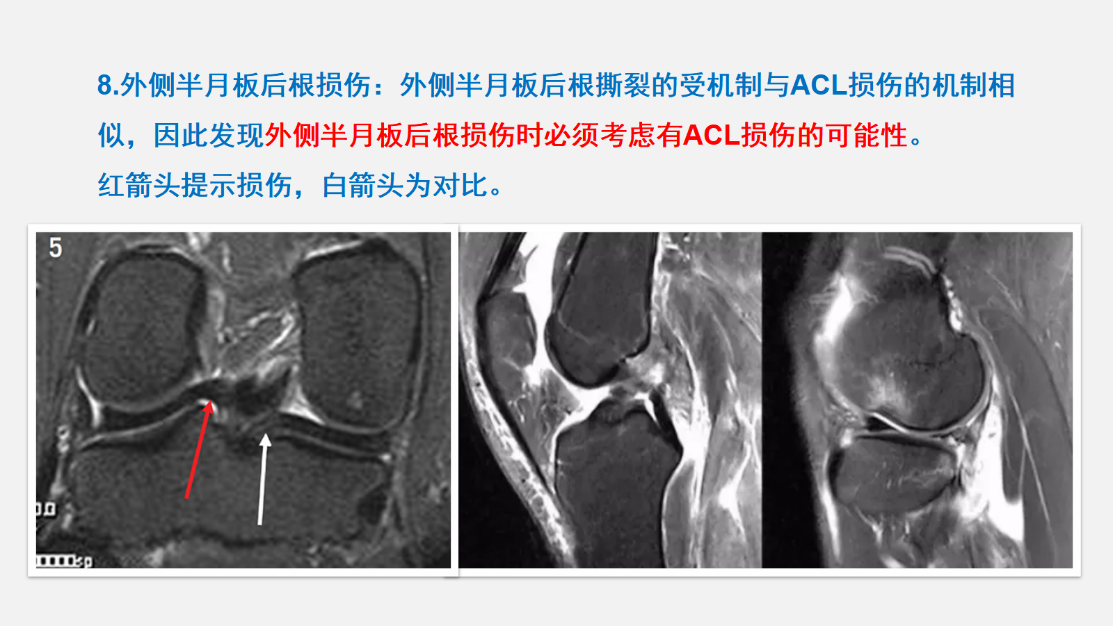 前交叉韧带（ACL）损伤的MRI诊断技巧，详细解析！ - 好医术早读文章 - 好医术-赋能医生守护生命
