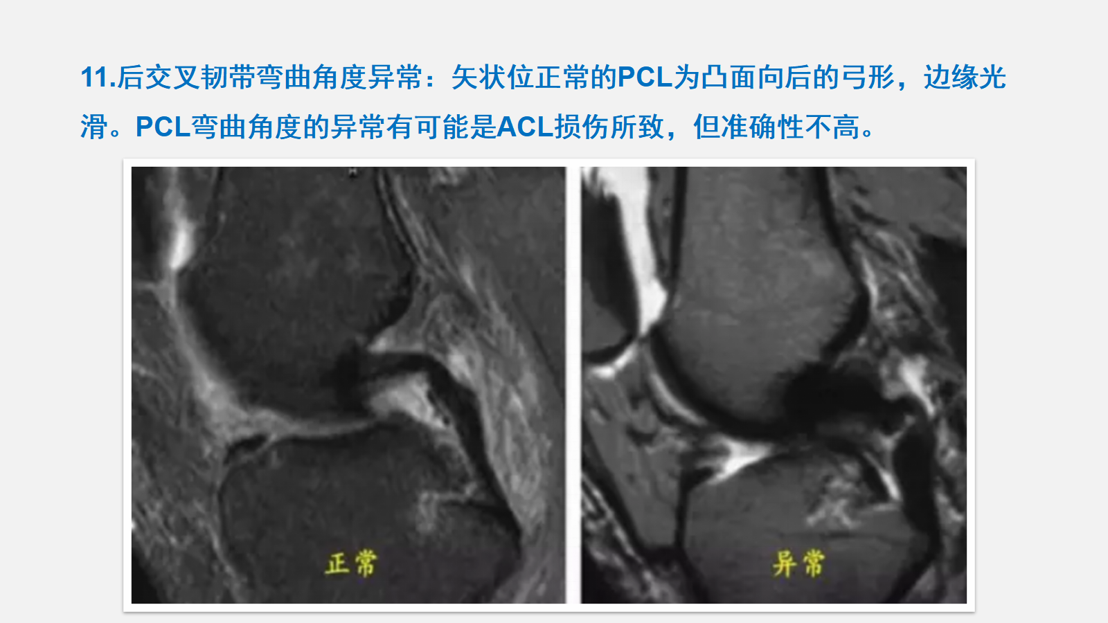 前交叉韧带（ACL）损伤的MRI诊断技巧，详细解析！ - 好医术早读文章 - 好医术-赋能医生守护生命