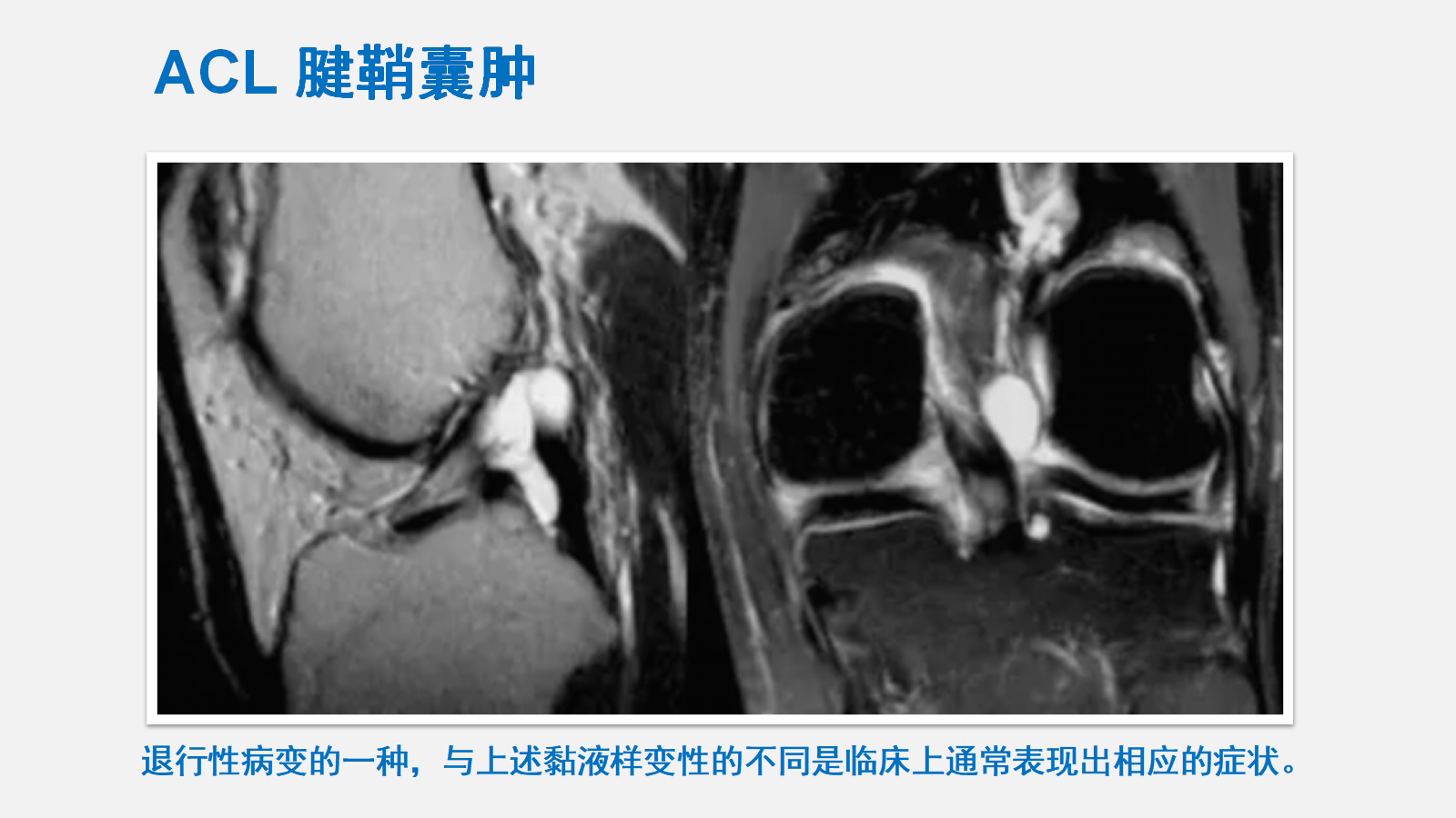 前交叉韧带 Acl 损伤的mri诊断技巧 详细解析 好医术早读文章 好医术 赋能医生守护生命