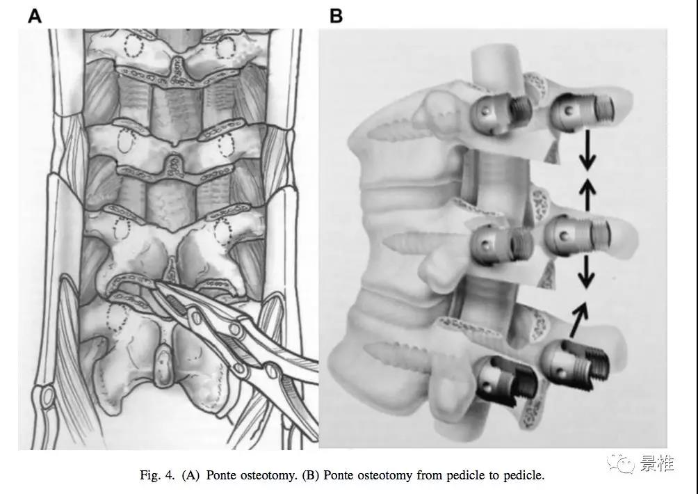 真正的ponte截骨看完就明白了