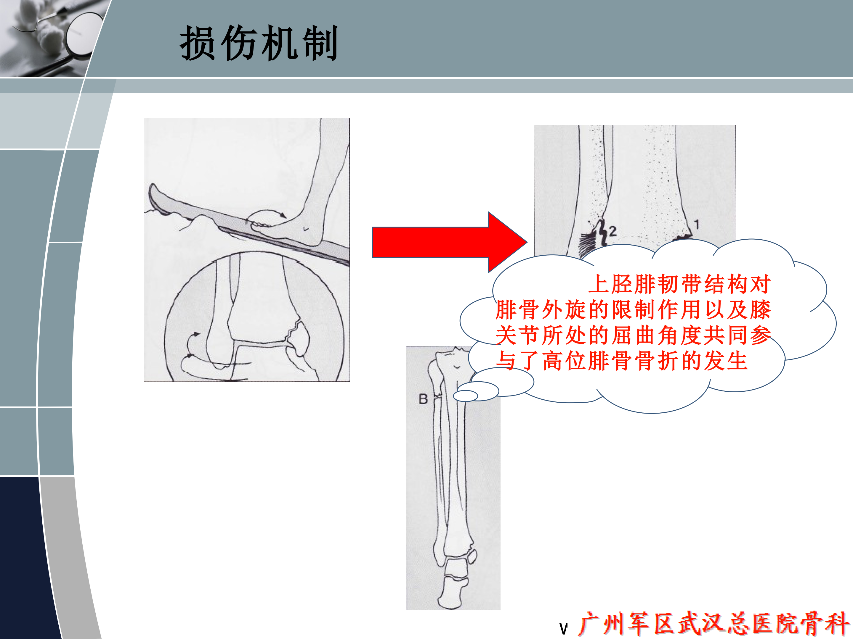 maisonneuve 骨折的手术治疗策略,看这篇就够了!
