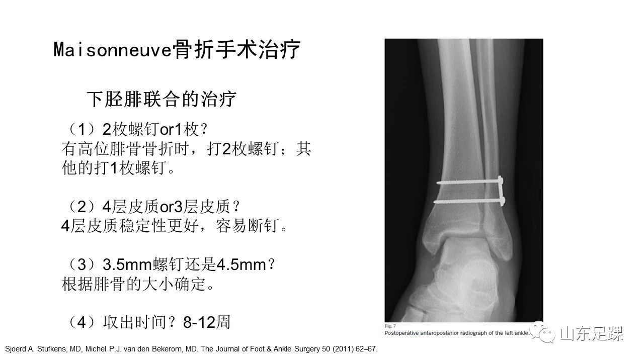 一篇掌握 Maisonneuve骨折的诊治技巧 好医术早读文章 好医术 赋能医生守护生命