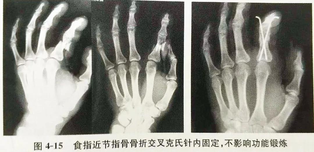 掌指骨骨折的固定方式选择 基础必备 好医术早读文章 好医术 赋能医生守护生命