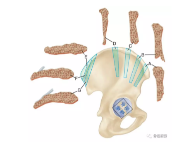 取髂骨植骨术技巧及要点,详细解析!