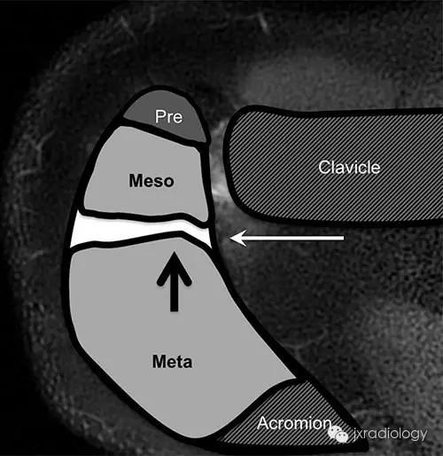 肩峰由四個骨化中心形成:前肩峰骨骺(pre),中間肩峰骨骺(meso), 後