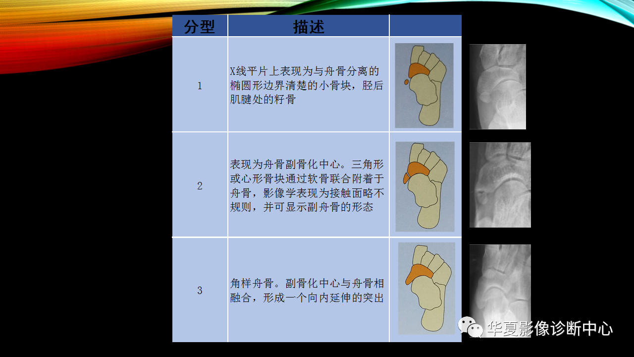 一文詳解:足副舟骨痛綜合徵!