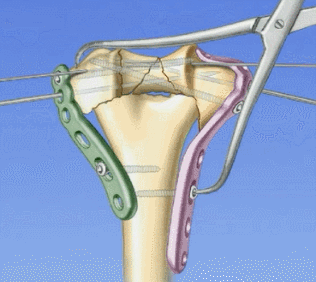 肱骨滑车解剖图图片