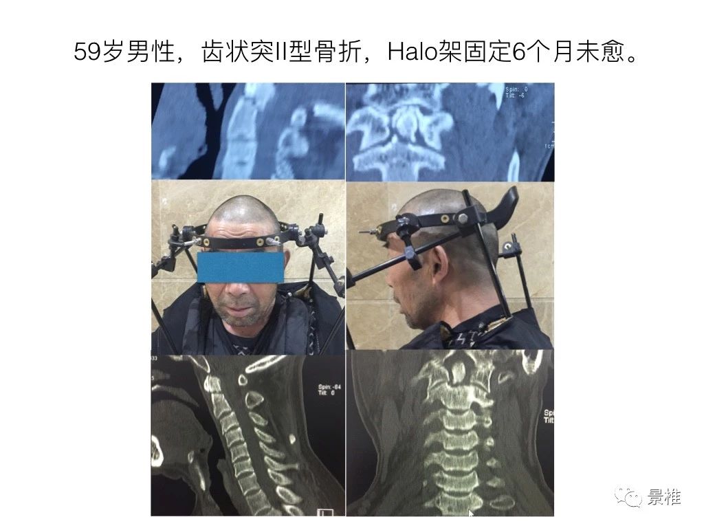 包括寰椎单椎节复位固定术,寰枢椎固定融合术,枕颈固定融合术等等.