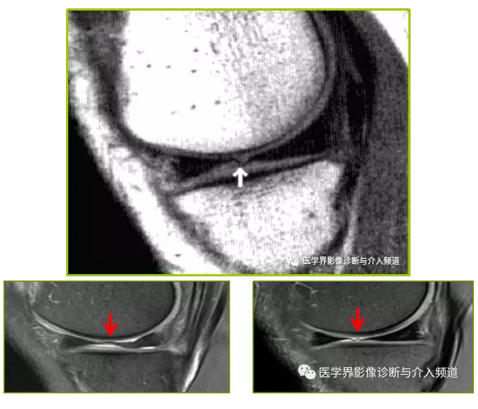 容易誤診為半月板損傷的10種結構