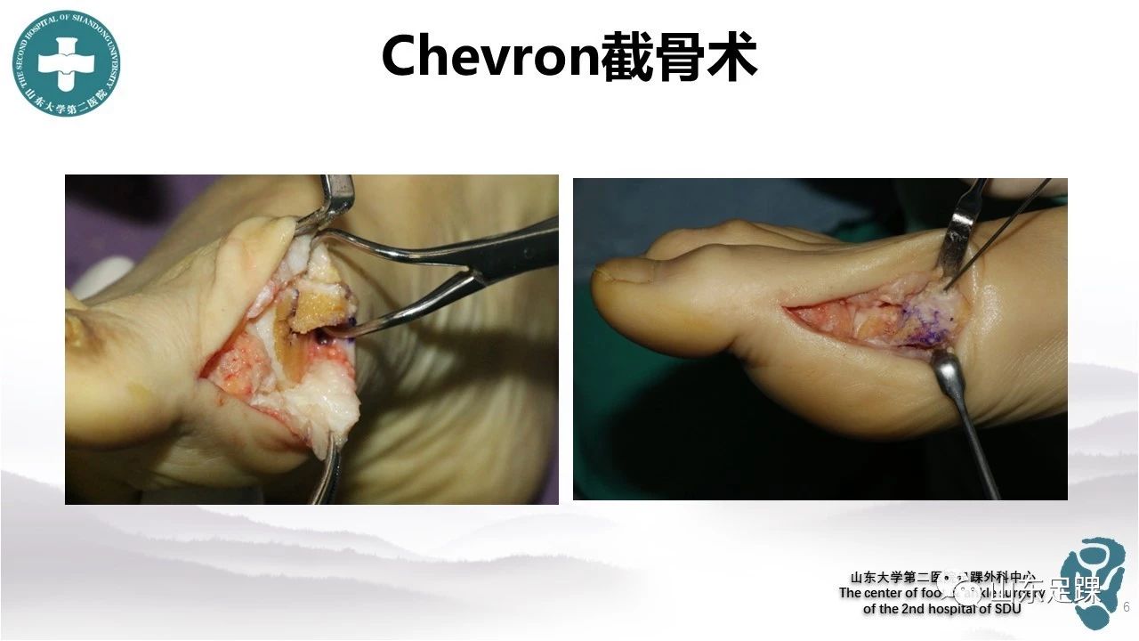 拇外翻chevron截骨内固定方式的选择