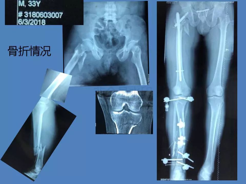 骨水泥技術——治療開放骨盆多發傷感染