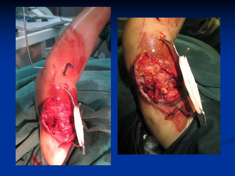 生理功能和生物力学性能都在不断变化,儿童骨头因骨质多孔,骨膜肥大等