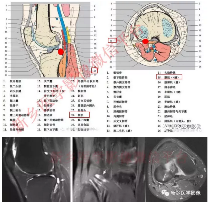 看了很多文章还是记不住膝关节的15个滑囊?试试这个吧!