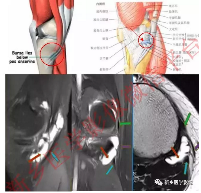 膝关节滑囊解剖图片