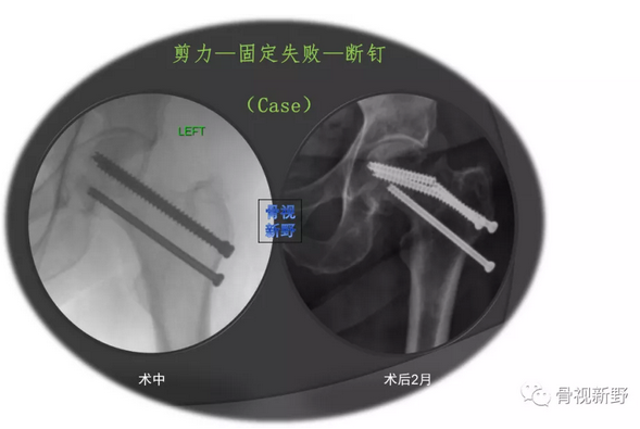 三枚空心拉力螺釘平行固定是股骨頸骨折最常見的內固定方法,但對於