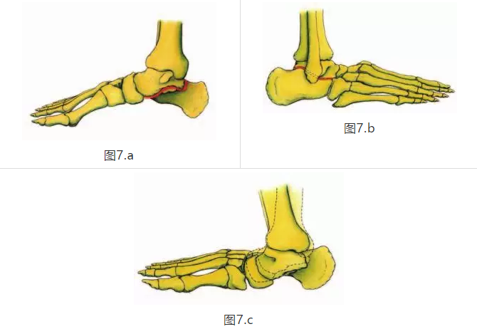 距下關節的運動對於在初始地面接觸期間,把腳從剛性槓桿轉換為在裝載