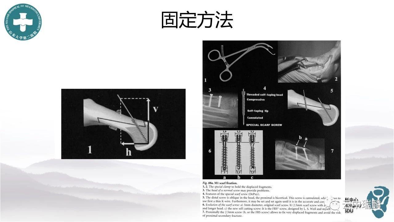 scarf截骨术治疗拇外翻的基本原理