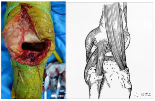 lcl)髂胫束(iliotibial tract,itb)挛缩的组织彻底清除骨赘再开始松解