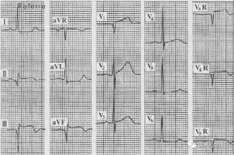 心肌梗死的定位诊断及相关心电图表现