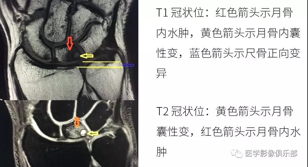 一文詳解:尺骨撞擊綜合徵的影像與診斷