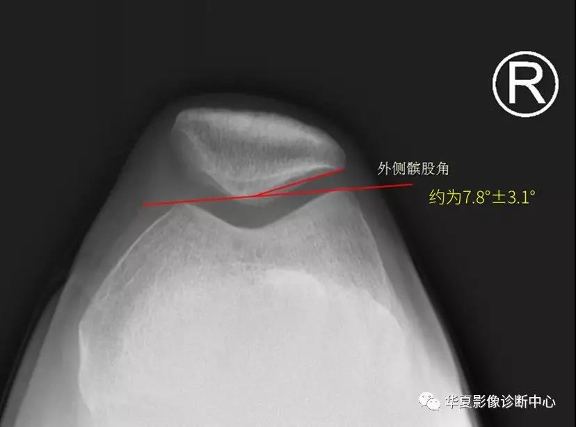 详细解读教你怎样评估髌骨位置