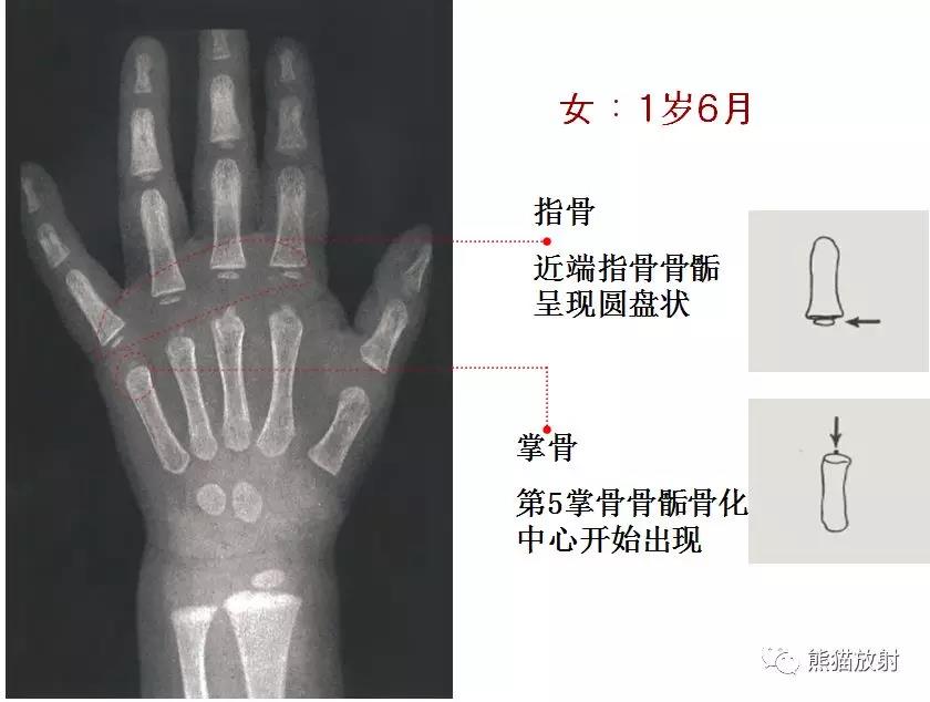 值得收藏的骨齡圖譜!方便隨時對照!