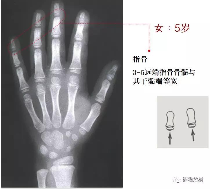 值得收藏的骨龄图谱!方便随时对照!