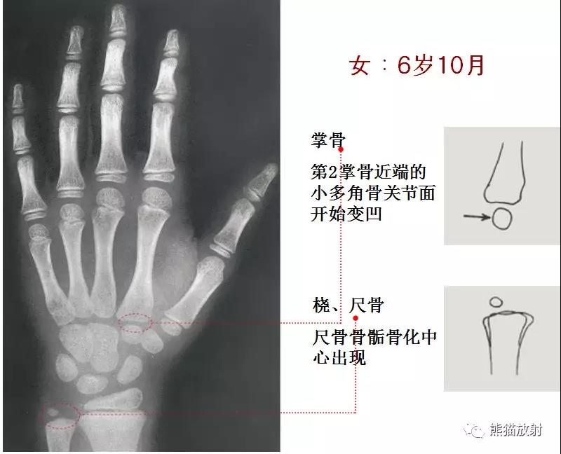 男孩骨齡圖譜本文來源:haoyisheng