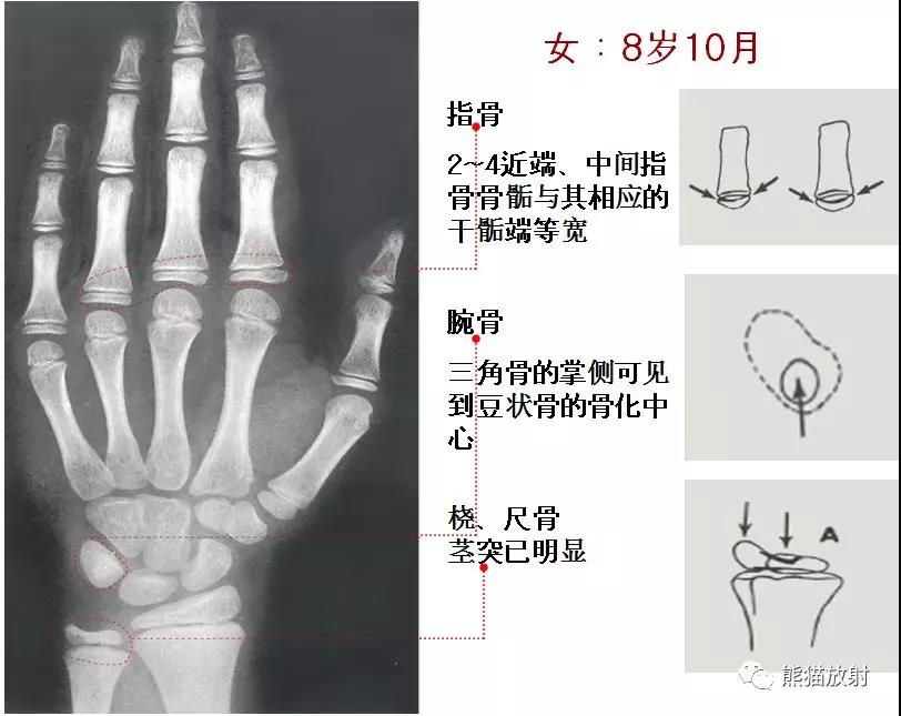 值得收藏的骨齡圖譜!方便隨時對照!