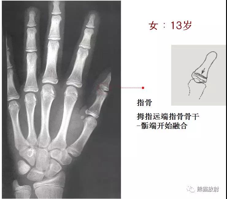 男孩骨齡圖譜本文來源:haoyisheng