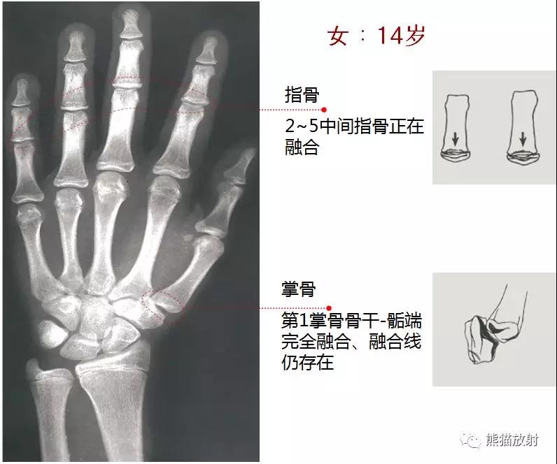 值得收藏的骨齡圖譜!方便隨時對照!