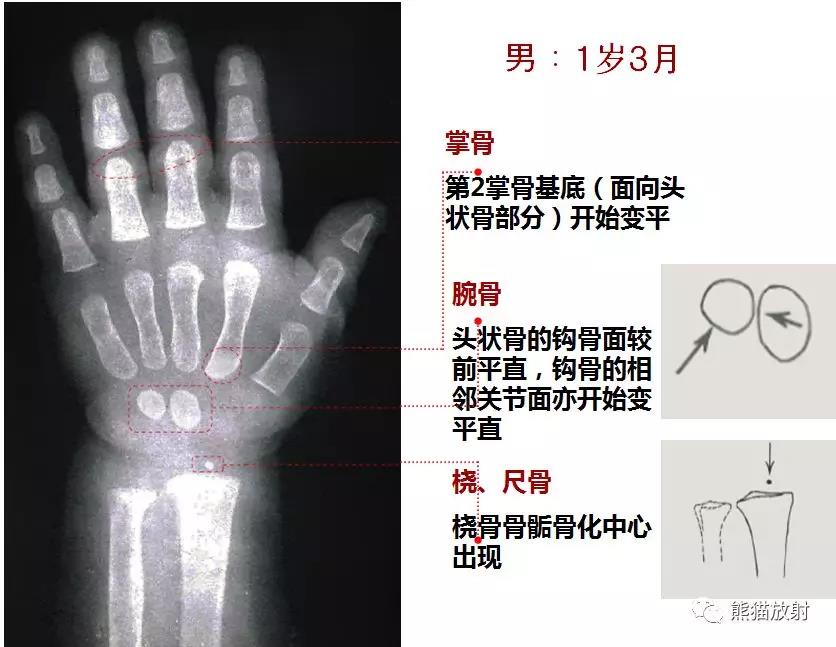 值得收藏的骨龄图谱!方便随时对照!