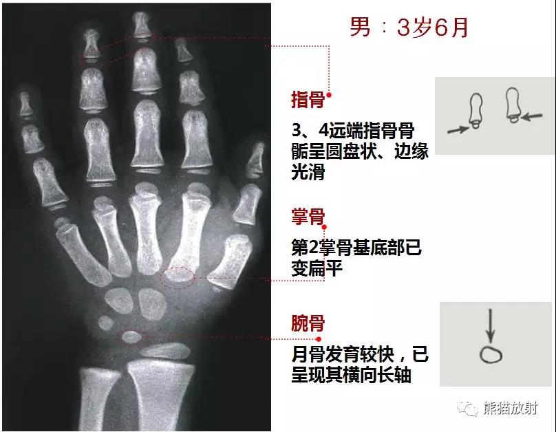 值得收藏的骨齡圖譜!方便隨時對照!