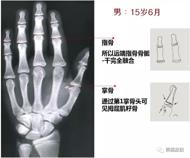 值得收藏的骨齡圖譜!方便隨時對照!