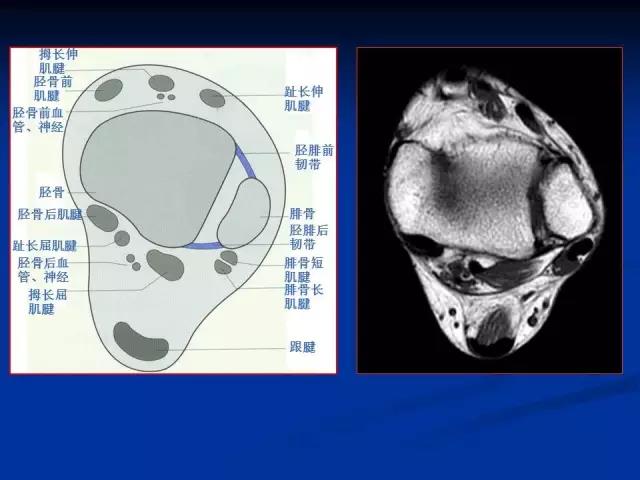 踝关节mri读片要点大全
