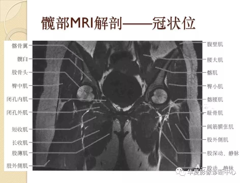 髖關節解剖及常見疾病的mri診斷,都在這裡了!