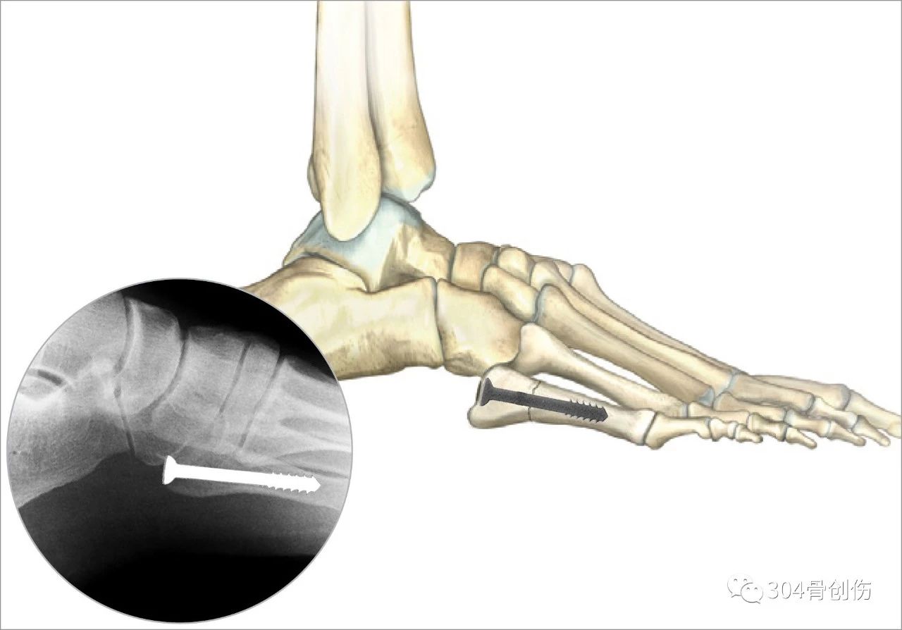 第5跖骨近端骨折髓内钉设计的影像学测量