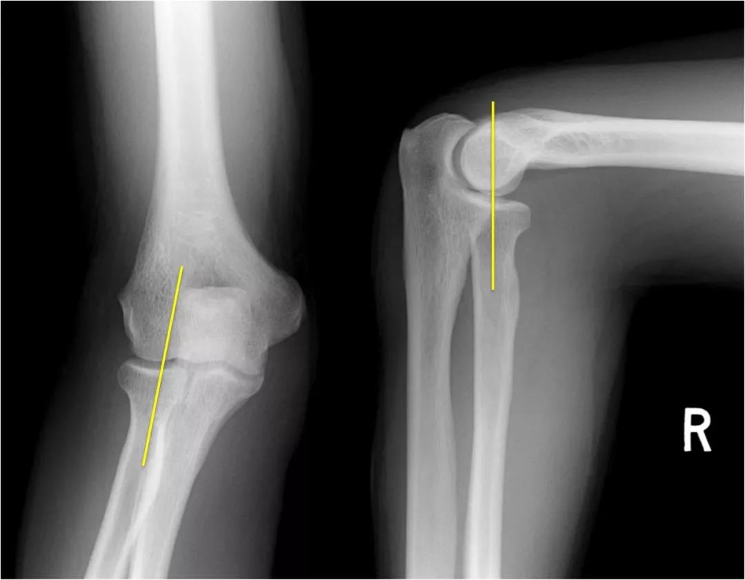 肘关节脱位的分析与治疗_肱骨