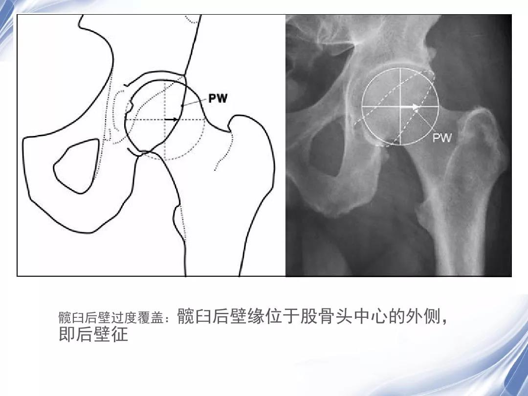 股髋撞击综合征（FAI）影像学诊断|影像学|FAI|髋关节|MRI|股骨头|股髋|X线|凸轮|-健康界