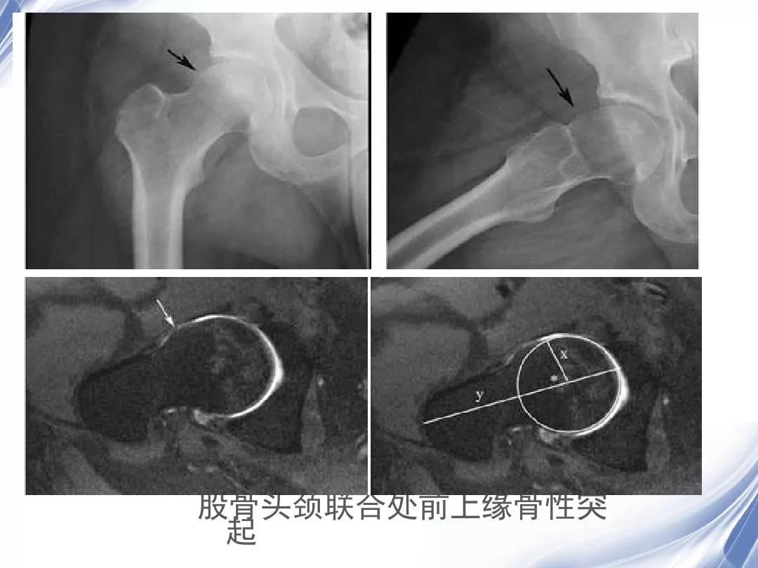 专业分享·X光片解读：股骨颈变形；髋关节间隙变窄，边缘骨质增生硬化改变_股骨头