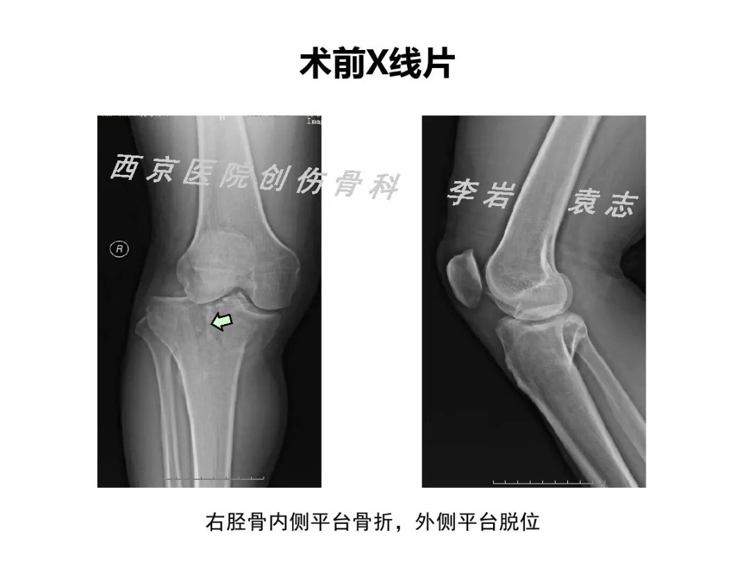 值得一看 胫骨平台 型骨折的手术治疗与探索 好医术早读文章 好医术 赋能医生守护生命