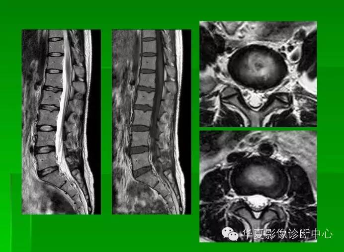 工作必备!椎间盘的突出,膨出,脱出和髓核游离,你会鉴别吗?