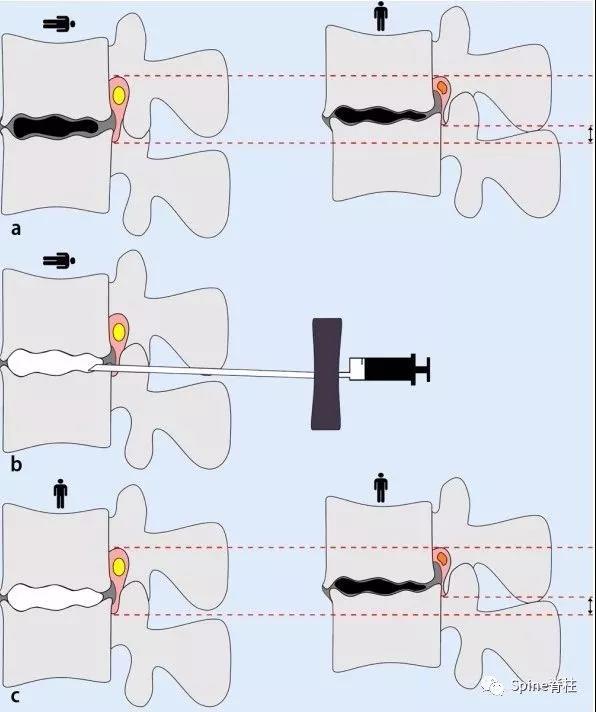 一种创新的骨科技术——经皮骨水泥椎间盘成形术!